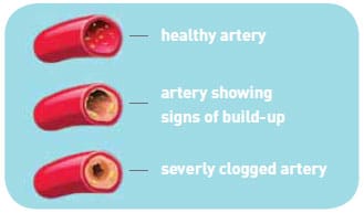 Healthy and severely clogged arteries