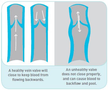 Vein valve illustration