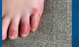coronavirus foot rash