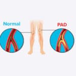 What is Peripheral Artery Disease (PAD) diagram