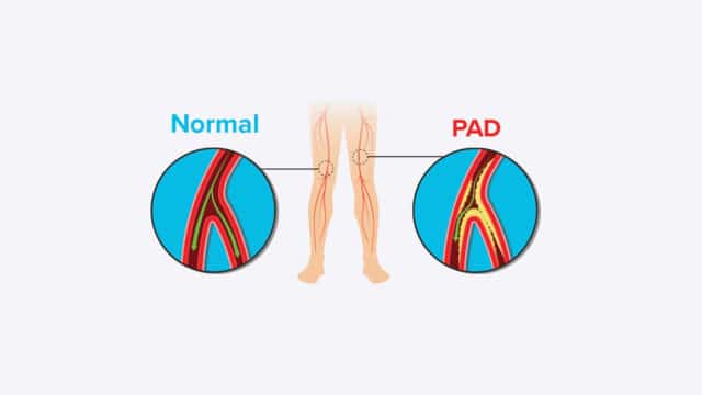 What is Peripheral Artery Disease (<mark class=