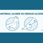 Arterial ulcers vs venous ulcers diagram