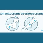 Arterial ulcers vs venous ulcers diagram