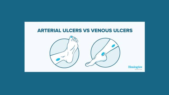 Arterial vs. Venous Ulcers: What Are the Differences? | Healogics