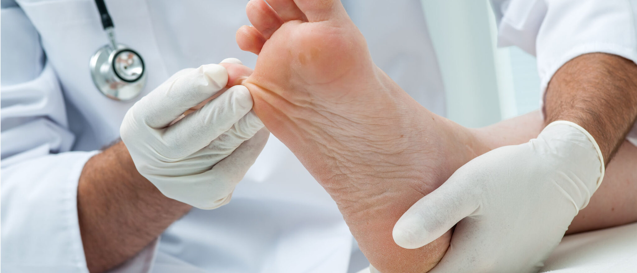 Management of Neuropathy and Related Ulcers